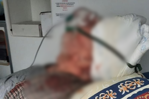 Отправили умирать с разбитой головой: в одесской больнице залечили пенсионера с Covid-19