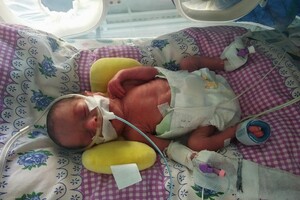 В Одессе медики спасли двух младенцев, которые весили менее 900 грамм 